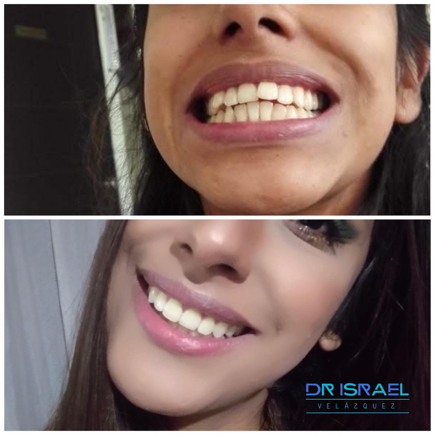 Antes y después de un tratamiento de ortodoncia en Zanäli Dental, CDMX