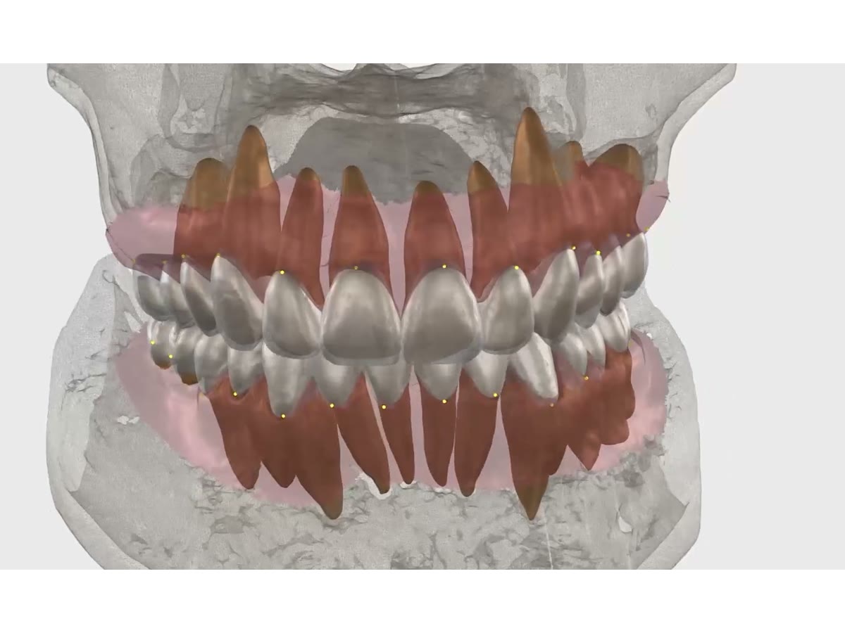 Modelo 3D de la dentición para visualizar la relación entre los dientes y las encías.
